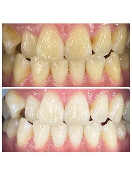 トムズ(Tom’s)/歯のセルフホワイトニング♪