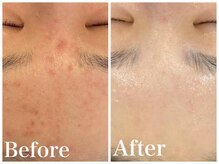 ノア 新宿(Noa)/ハーブピーリング＋マシン 6回