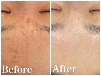 ノア 新宿(Noa)/ハーブピーリング+マシン 6回