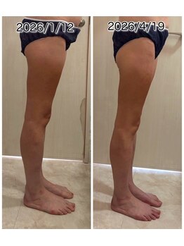 クールスパ(COOL SPA)/40代女性 脚症例