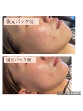 エスデザイン(es design)/フェイシャル／くすみ改善／美白