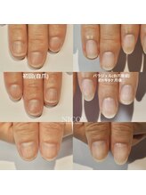 ニコプラス(NICO+)/自爪育成中