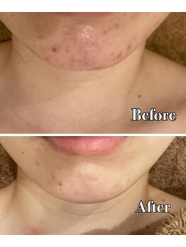 メナードフェイシャルサロン 片町店/ニキビ肌荒れ根本ケア