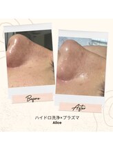 アリス(Alice)/ハイドロ洗浄