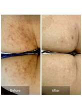 ビビ(VIVI)/ハーブピーリング症例（お尻）