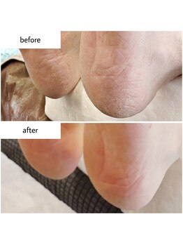 ケアプラス(care plus)/足裏角質ケア