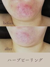 エクラ(eclat)/ハーブピーリング