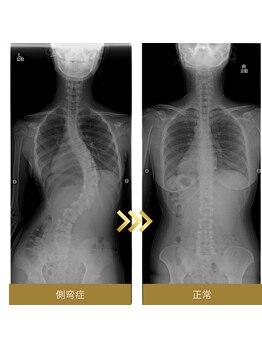 リチカ(RITICA)/側弯による神経圧迫