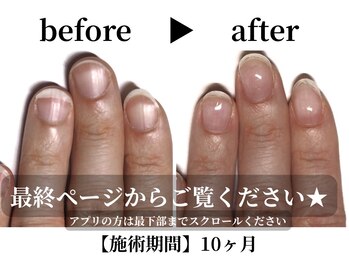 深爪プレミアムコース¥18,700