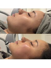 ビズビズ(bizz bizz)/オンダリフトむくみ脂肪に特化