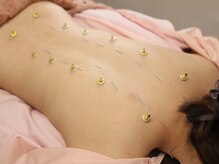 ボディラボ鍼灸整骨院(BODY LAB.鍼灸整骨院)の雰囲気（痛みの少ない優しい鍼と温かいお灸での全身ケアも行っています）