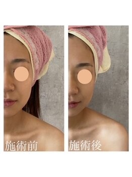 リベラ(Re:BELLA)/本格小顔コルギ＆石膏パック