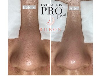 トータルビューティサロン ルボン(RUBON)/毛穴エクストラクション