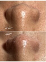 スパークル/毛穴/ワックス脱毛/毛穴洗浄