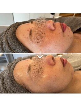 ブルームーン(Blue Moon)/REVI 1回施術