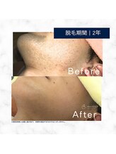 メンズクリア 武蔵小杉店/【メンズクリア】お客様の施術例