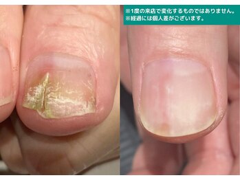 地爪ケアクリニックサロン 代々木店/割れ、欠け、亀裂でお悩みの方に