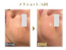 《ミコステラ/メラショット６回》シミやニキビを改善しツヤ肌へ