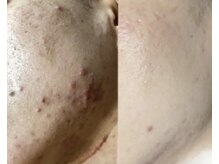 ムーンリズム(Moonlism)/【TIPハーブ症例】ニキビ・跡