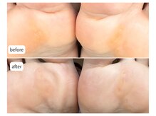 カシェット(Cachette)/40代女性◎足裏角質ケア90分