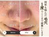 【毛穴ケアの最高峰】黒ずみ除去エクストラクション＋たるみ小顔ケア付90分