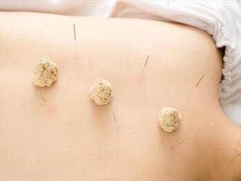 つつじが岡整骨院・鍼灸院の写真/【本格美容鍼で小顔へ】深層筋から引き上げる驚きのハリ感!たるみ・くすみを解消し自信の持てる素肌へ♪