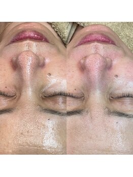 アネモネ(ANEMONE)/韓国式ハーブピーリング