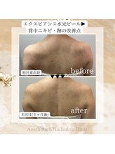 ビヌ(Binu)/背中水光ピール