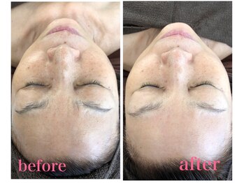 ティアラ(TIARA)/韓国ピーリング「ムルトックス」