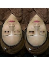 ミヨン(Miyong)/LDM Aquaで透明感のあるお肌へ