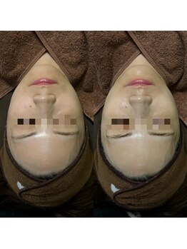 ミヨン(Miyong)/LDM Aquaで透明感のあるお肌へ