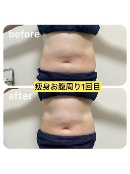 ルクール(Le Couer)/５０代痩身１回の効果