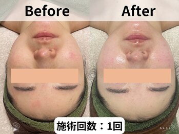 ナナ(nana)/ハーブピーリング|美白ケア