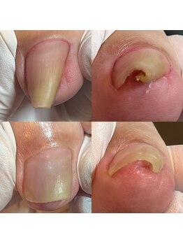 ウェルズユキ(well's yuki)/巻き爪 変形爪 陥入爪