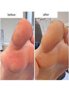 ケアプラス(care plus)/足裏角質ケア