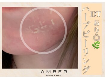 アンバー 恵比寿(AMBER)/DT有ハーブピーリング