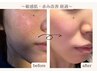【肌改善入門】全国症例数No,1のドクターリセラ×AI肌診断☆本格ケア40分