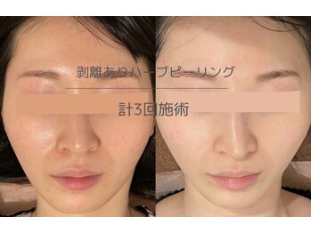 ライフサロン 恵比寿(Life Salon)/艶々の美肌に♪