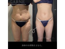 ガーネ 堺店(GARNE)/痩身・脂肪分解12回/20代後半