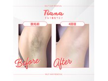 セルフでも数回でツルツルに！(セルフ脱毛/全身脱毛/VIO脱毛）