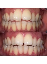 エール(aile)/うるま市セルフホワイトニング