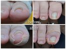 【巻き爪】特殊ジェルでリフト