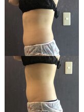 ナラビューティー(NARA BEAUTY)/◇輪郭一回の効果 ◇