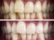 コハク(kohaku)/白い歯維持に！