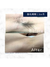 メンズクリア 武蔵小杉店/【メンズクリア】お客様の施術例