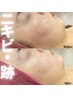 【ニキビケア/毛穴】 陶肌トリートメント/シルク・エンザイム《初回価格》