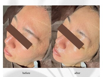 アン ビューティー(ann beauty)/施術1回【症例写真】40代