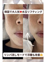 マウム(Maum)/フェイスラインのぼやけは浮腫？