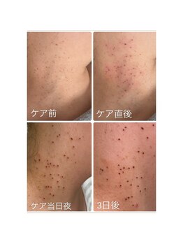 プライベートサロン プース(pousse)/首イボケア