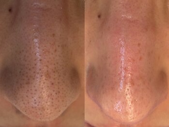 サイセイ(SAISEI)の写真/毛穴汚れゴッソリ【毛穴ハイドラ洗浄★¥6980】自社開発の化粧品だから他と結果が違う!